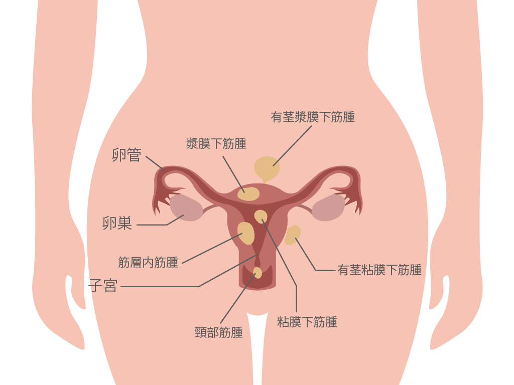 ポリープ 管 子宮 頚